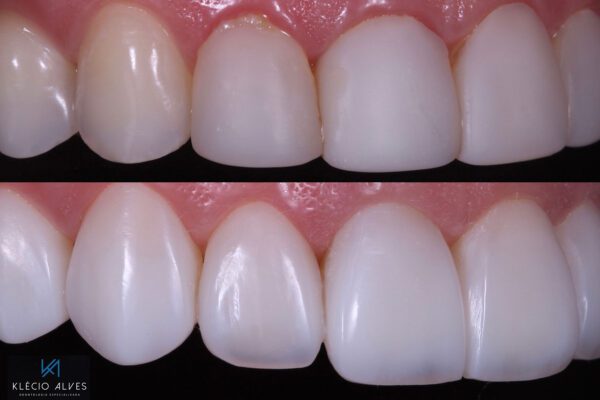 Cosmetic Dentist Dr. Kelcio Alves Before and After photo using Composite Resin