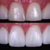 Cosmetic Dentist Dr. Kelcio Alves Before and After photo using Composite Resin