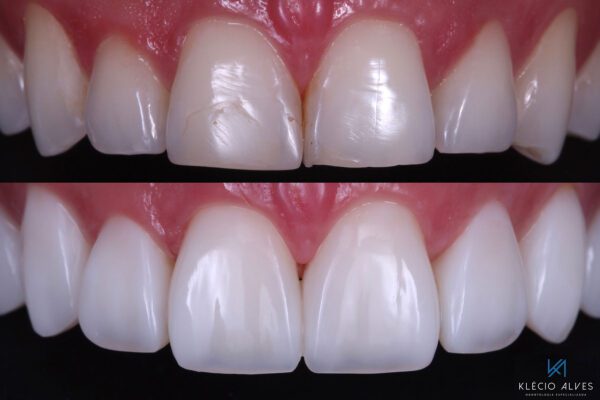 Cosmetic Dentist Dr. Kelcio Alves Before and After photo using Composite Resin