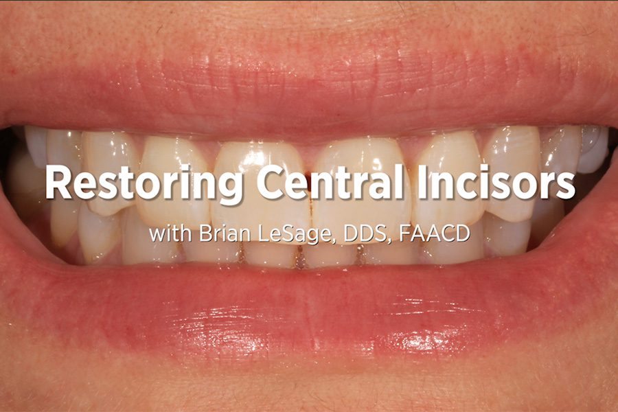 Restoring Central Incisors with Composite
