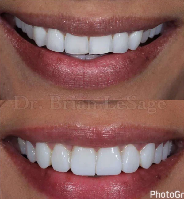 Composite Skills You Need to Attain Porcelain-like Results - Image 2