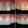 Dennis Hartlieb Dental CE Course Discover Composite Bonding Techniques for Success