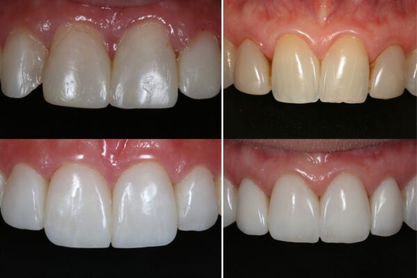 Dennis Hartlieb Dental CE Course Discover Composite Bonding Techniques for Success