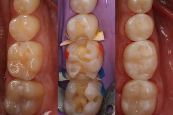 Dennis Hartlieb Dental CE Course Discover Composite Bonding Techniques for Success