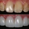 Dennis Hartlieb Dental CE Course Discover Composite Bonding Techniques for Success