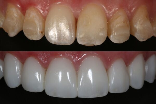 Dennis Hartlieb Dental CE Course Discover Composite Bonding Techniques for Success