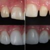 Dennis Hartlieb Dental CE Course Discover Composite Bonding Techniques for Success