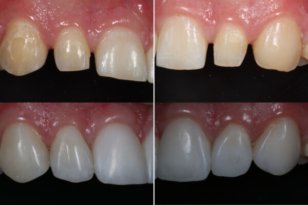 Dennis Hartlieb Dental CE Course Discover Composite Bonding Techniques for Success