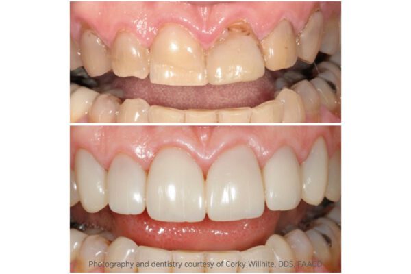 Dr. Corky Willhite Composite Before and After 2