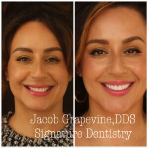 Jacob Grapevine DDS Composite Veneers Before and After