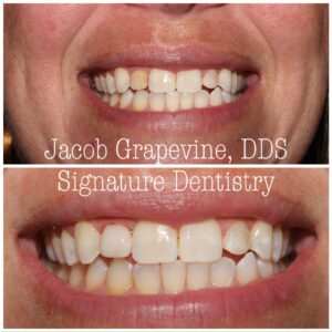 Jacob Grapevine DDS Composite Veneers Before and After