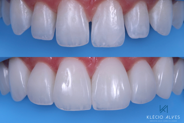 Cosmetic Dentist Dr. Kelcio Alves Before and After photo using Composite Resin