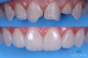 Cosmetic Dentist Dr. Kelcio Alves Before and After photo using Composite Resin