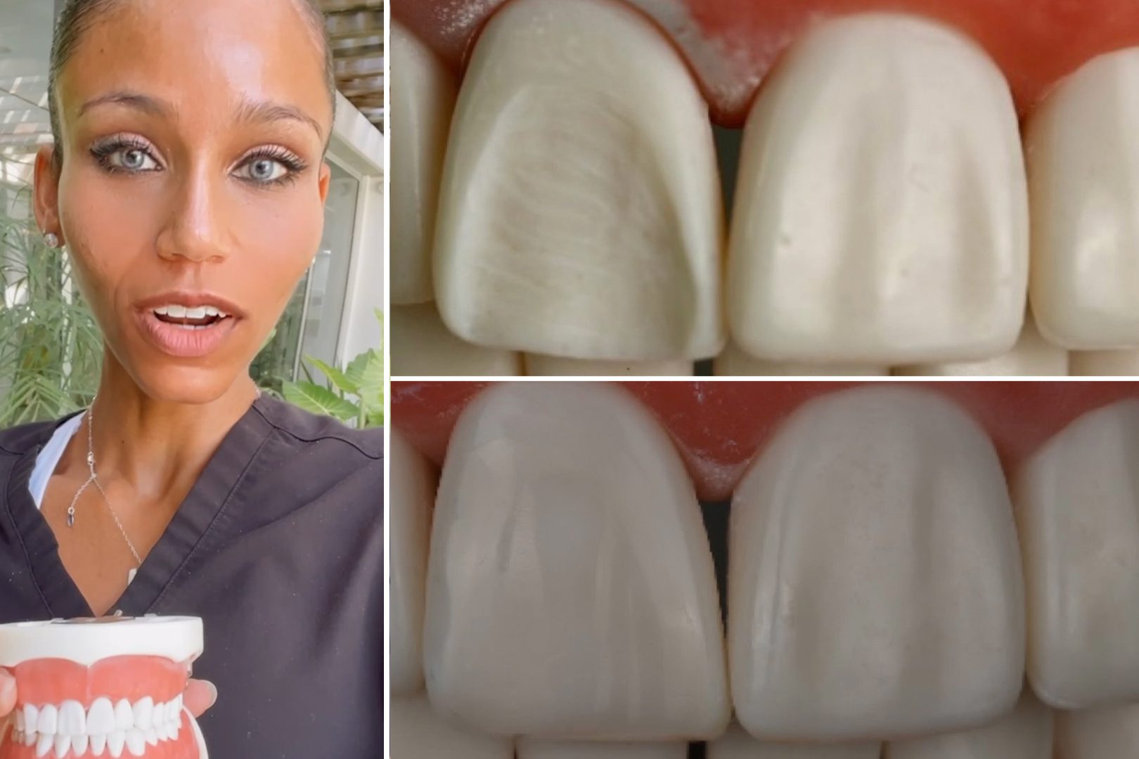 Stepbystep guide to finishing and polishing composite restorations