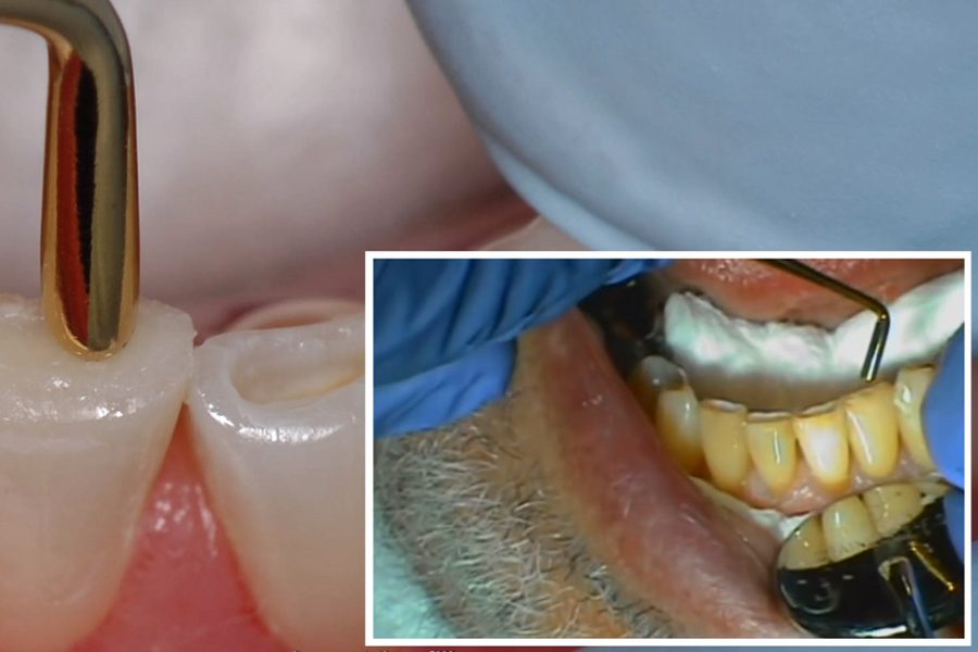 Reinforcing Worn Incisal Edges with Composite Resin