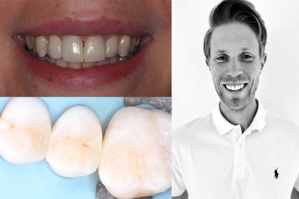 Boost your Restorations — Anterior and Posterior Composites with Mathias Kühn, DDS