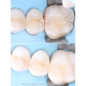 Mathias Kühn, DDS Posterior Composite Restoration Before and After