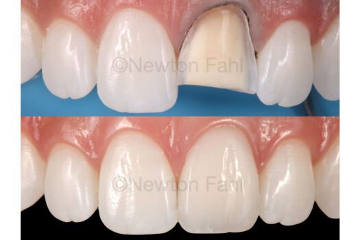 fahl-before-after-central-incisor-1