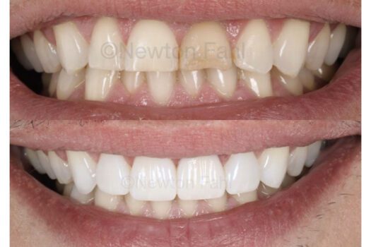 fahl-before-after-central-incisor-2