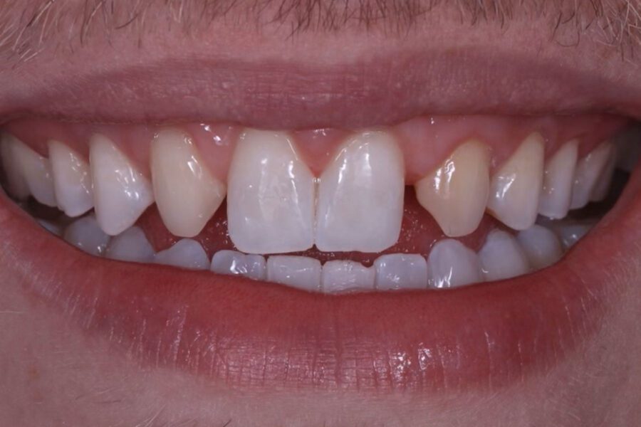 Opalite Renamel Microfill Composite Before Image by Klecio Alves, DDS