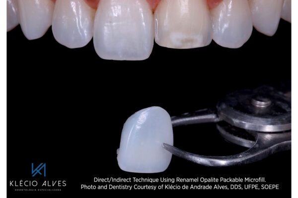 Opalite Renamel Microfill Composite with work by Klecio Alves, DDS
