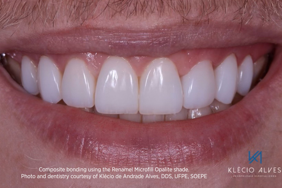 Opalite Renamel Microfill Composite After Image by Klecio Alves, DDS