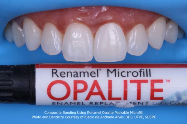 Opalite Renamel Microfill Composite with work by Klecio Alves, DDS