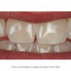 Opalite Renamel Microfill Composite with work by Carolyn Kittell, DDS