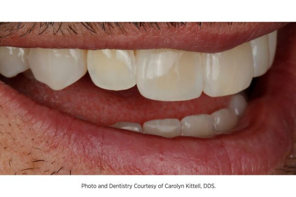Opalite Renamel Microfill Composite with work by Carolyn Kittell, DDS