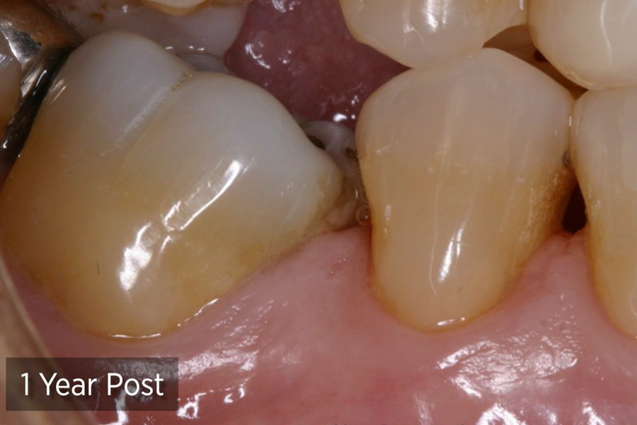 Class V Cervical Restorations