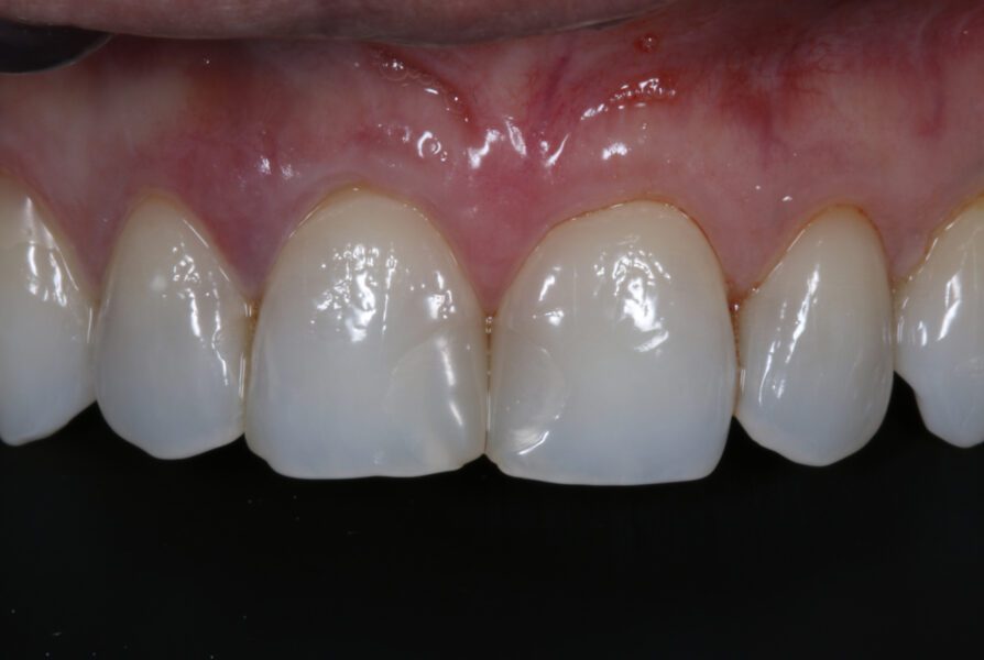 Dennis Hartlieb Dental CE Course Discover Composite Bonding Techniques for Success