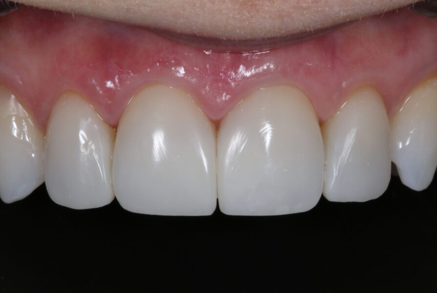 Dennis Hartlieb Dental CE Course Discover Composite Bonding Techniques for Success