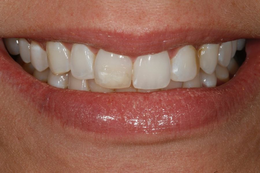 Dr. Corky Willhite Before Composite Restoration