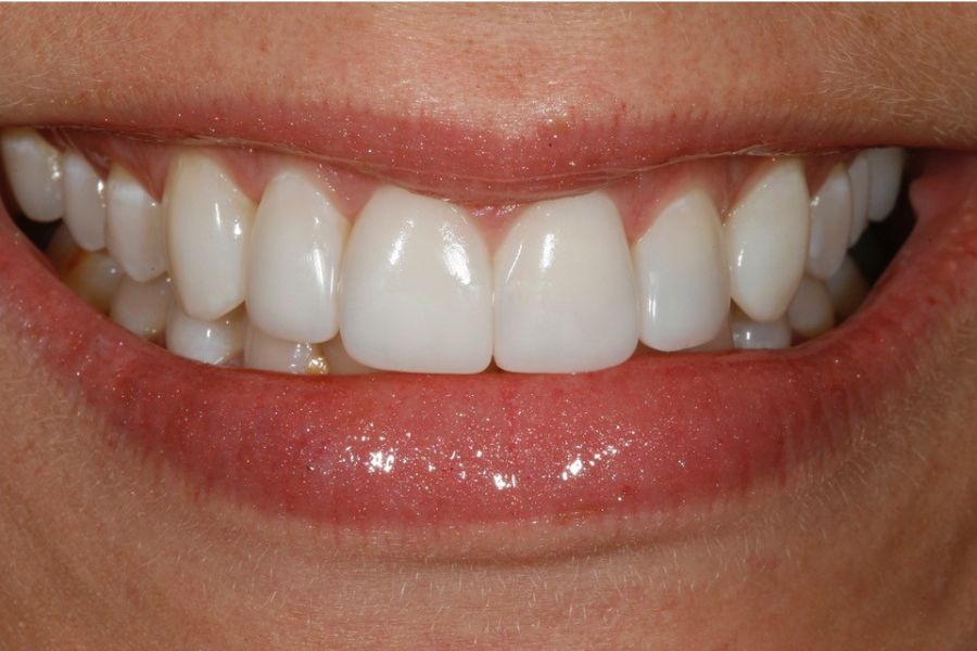Dr. Corky Willhite After Composite Restoration