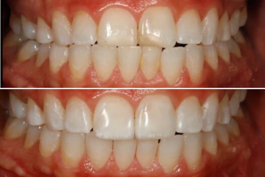 cee-willhite-before-after-1124-1