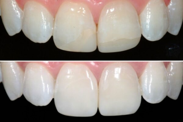 Dr. Corky Willhite Before and After Composite Restoration