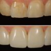 Dr. Corky Willhite Before and After Composite Restoration