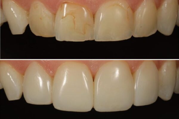Dr. Corky Willhite Before and After Composite Restoration