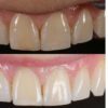 Dentist Arthur Volker uses composite for a direct anterior restoration