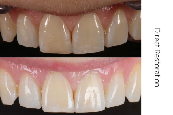 Dentist Arthur Volker uses composite for a direct anterior restoration