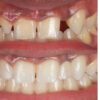 Dentist Arthur Volker uses both direct and indirect methods for this dental restoration
