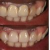 Dr. Arthur Volker determined indirect dental techniques made sense for this anterior restoration.