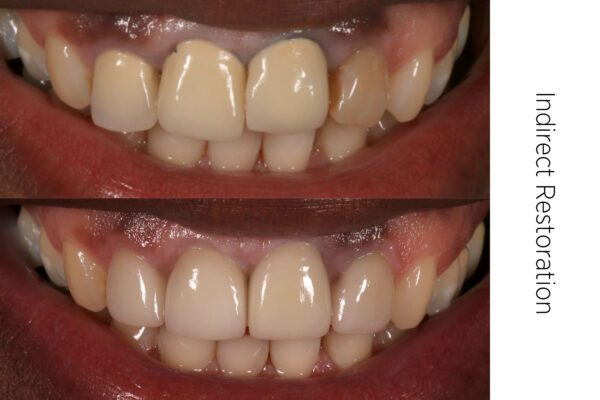 Dr. Arthur Volker determined indirect dental techniques made sense for this anterior restoration.