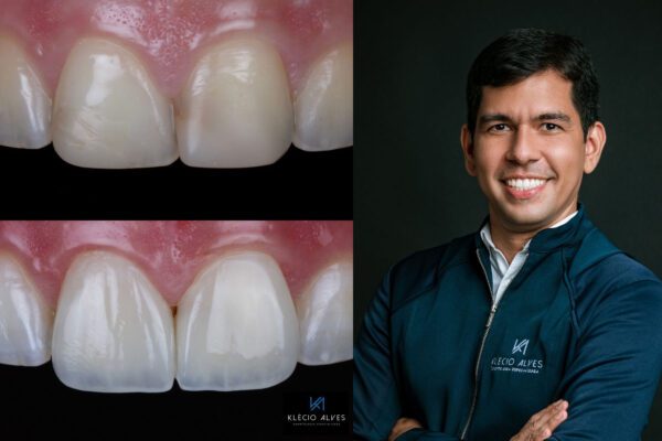 Klecio Avles webinar showcasing the details that elevate composite restorations