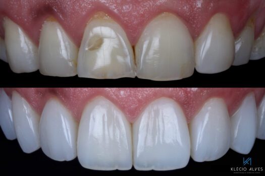 alves-before-after-opalite-1800x1200px